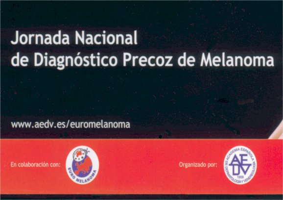 diagnóstico precoz de melanoma